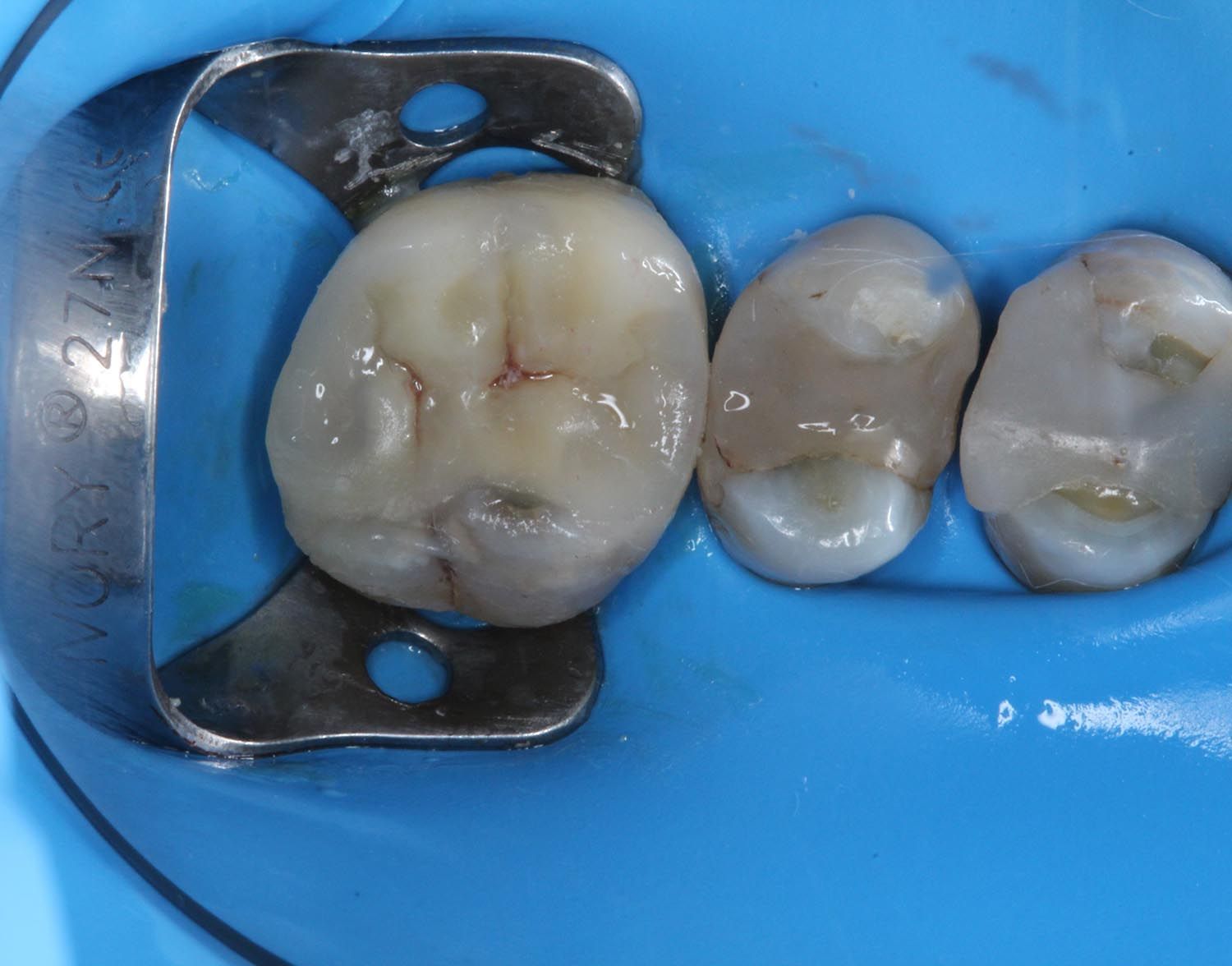 Primo piano dentale di molari isolati con diga di gomma e morsetto metallico durante il trattamento.