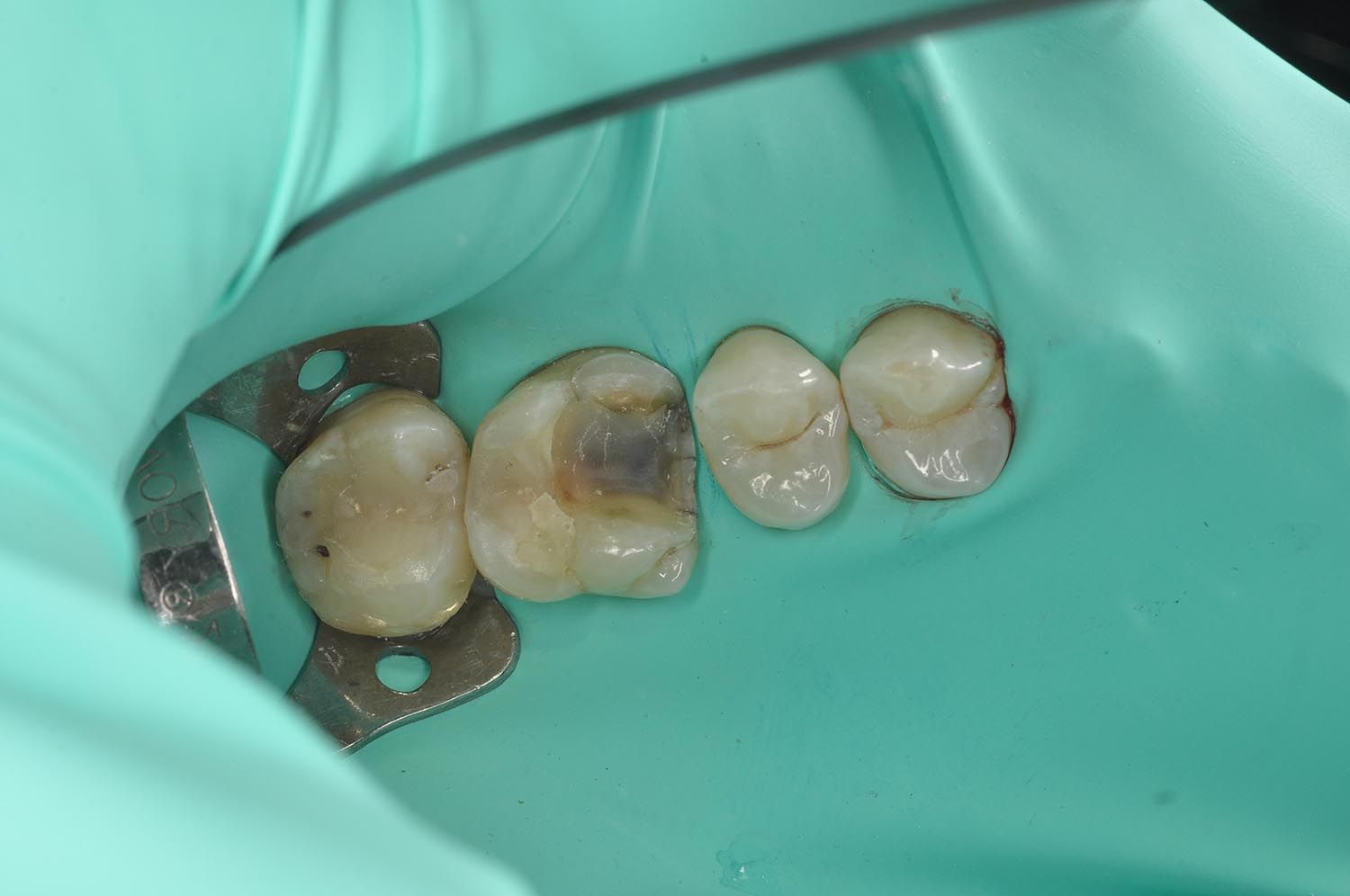Primo piano di molari isolati con una diga di gomma dentale verde e un morsetto metallico.