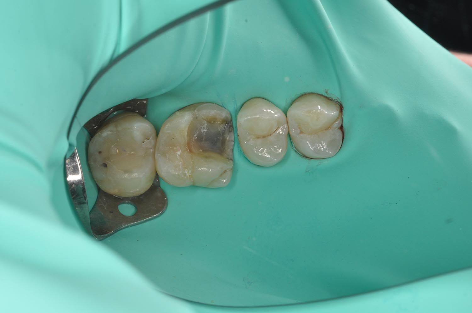 Denti isolati con diga di gomma dentale color verde acqua e morsetto metallico durante una procedura odontoiatrica.