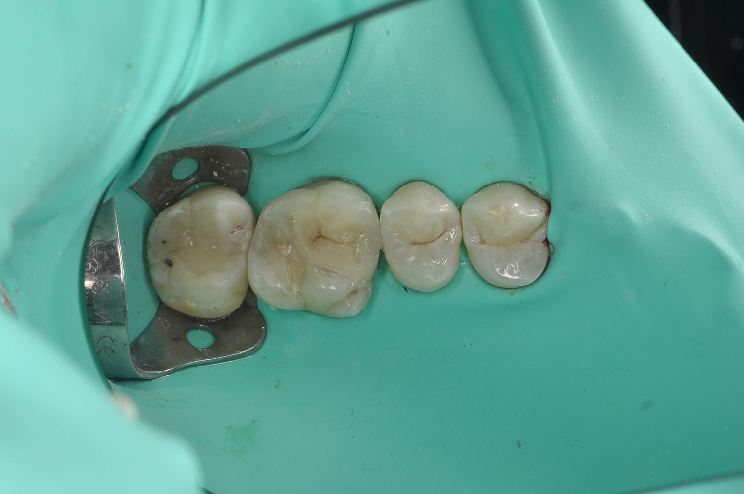 Primo piano di quattro molari isolati con una diga dentale verde durante una procedura odontoiatrica.
