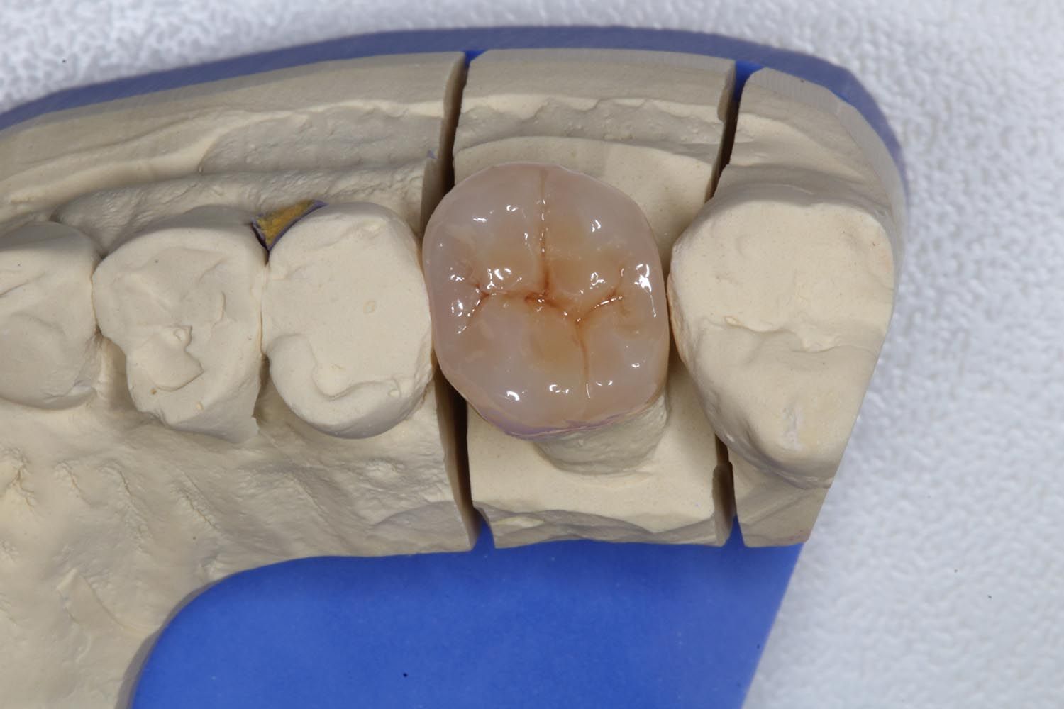 Modello dentale con restauro dentale rosa al centro tra denti bianchi e base blu.
