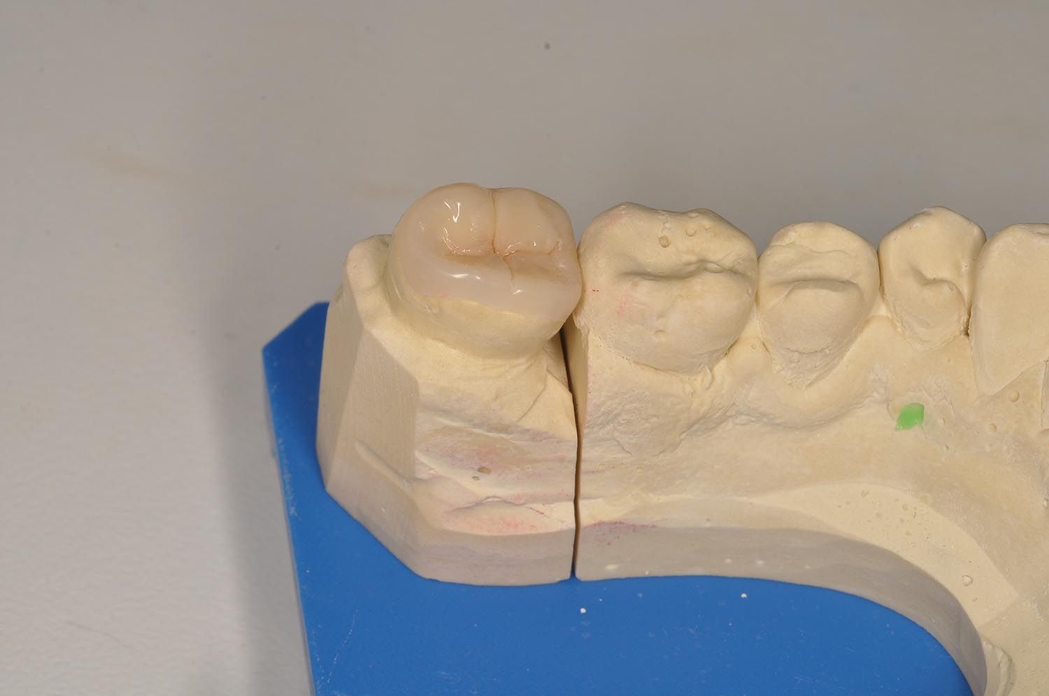 Calco dentale dei denti superiori su base blu