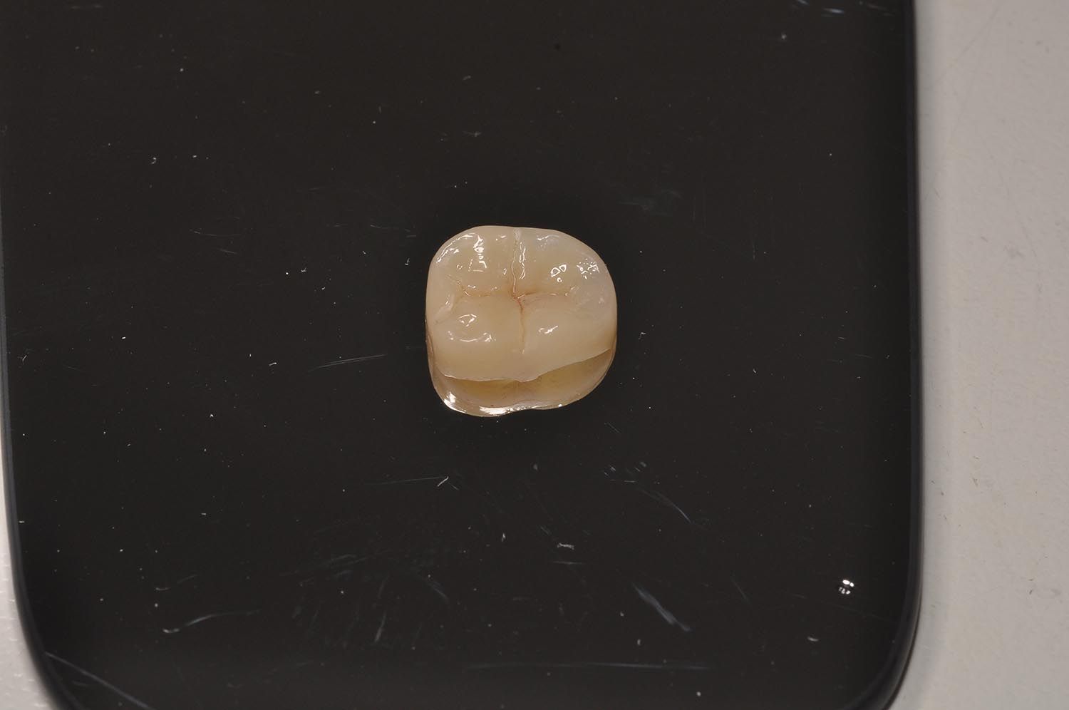 Piccola corona dentale beige su sfondo nero