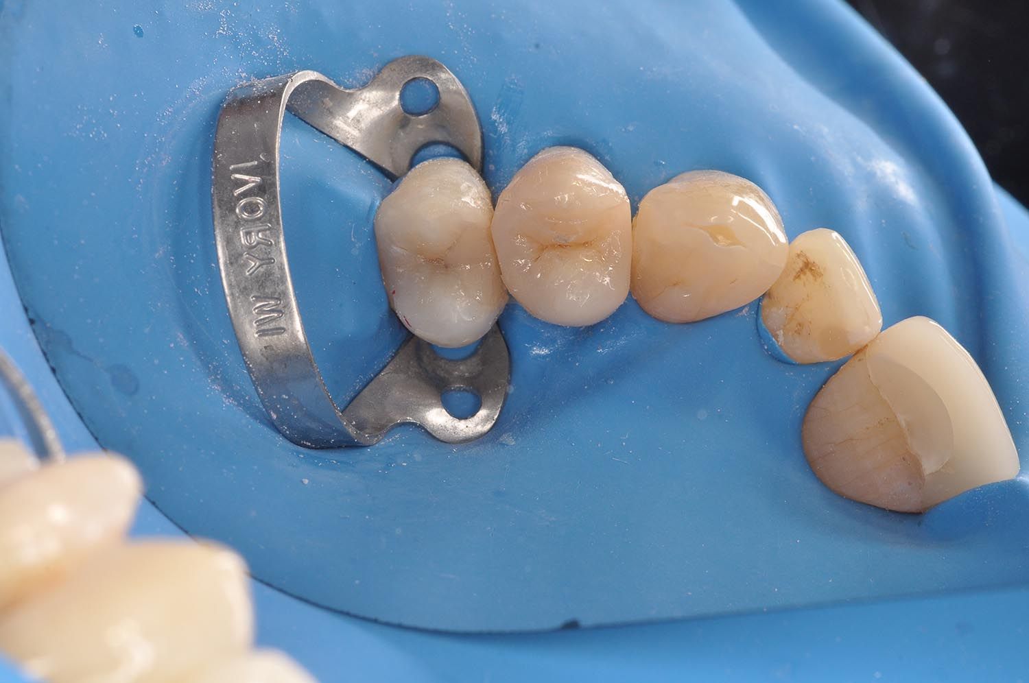 Diga dentale blu che isola un dente con un morsetto metallico e mostra i denti adiacenti