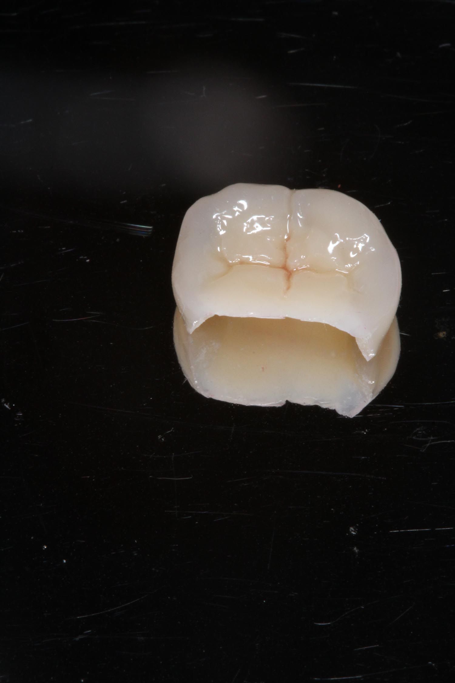 Primo piano di una corona dentale bianca o di un restauro molare su sfondo nero.