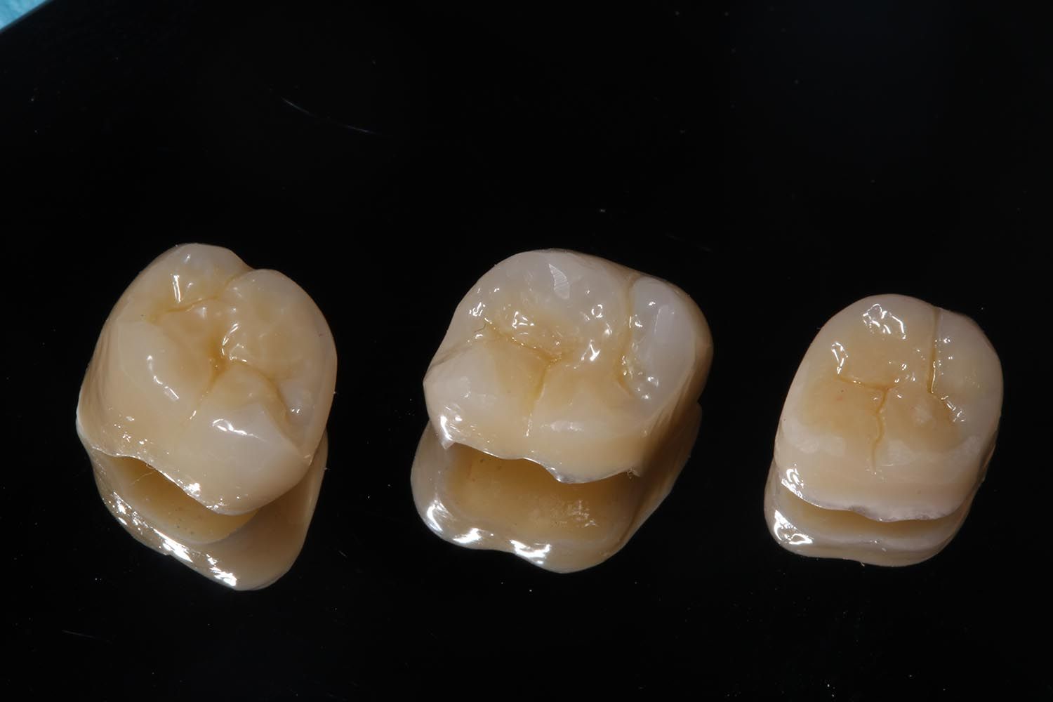 Tre molari estratti su sfondo nero, mostrati uno accanto all'altro.