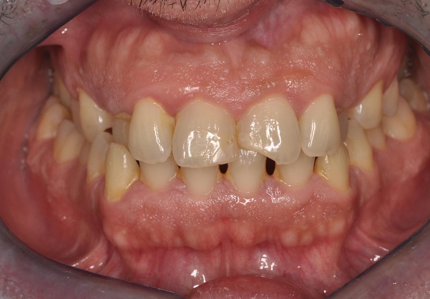 Primo piano di denti con evidente affollamento e spazi vuoti, labbra tirate indietro per mostrare i denti anteriori e le gengive.