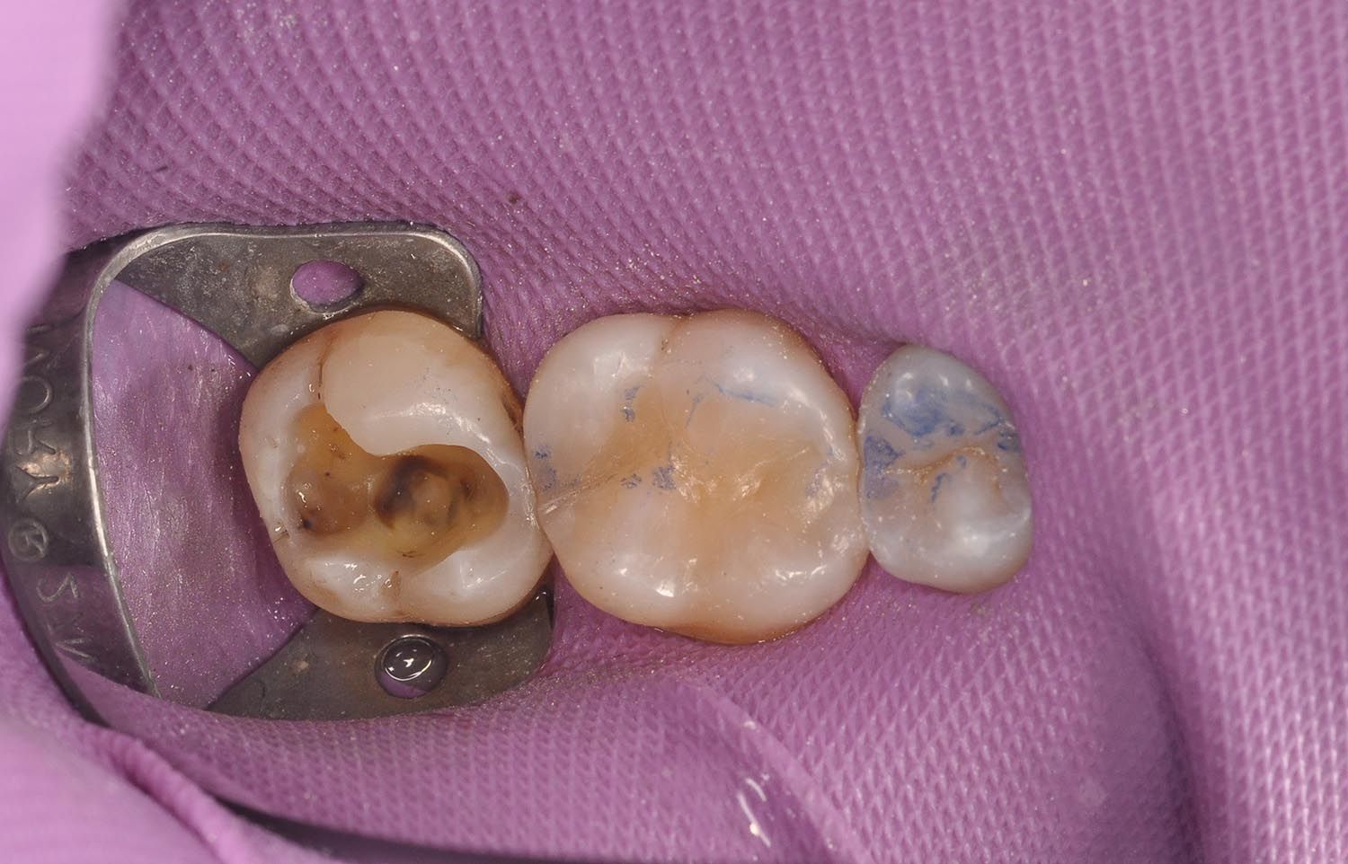 Primo piano di due molari con intervento odontoiatrico sotto una diga di gomma viola.