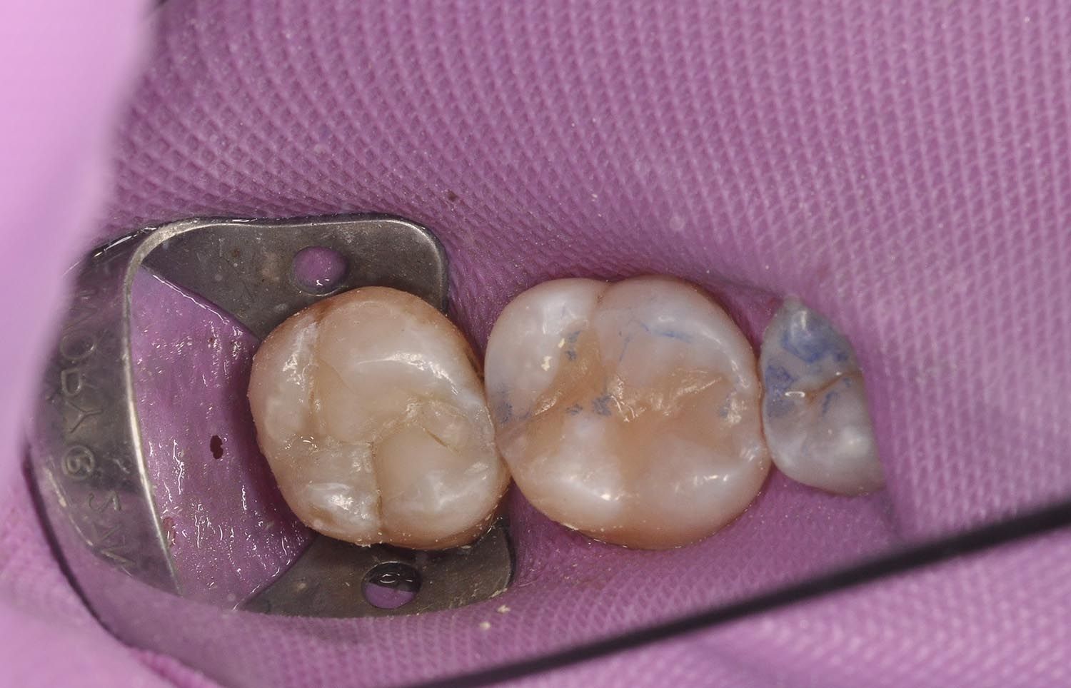Primo piano di molari isolati con una diga di gomma rosa durante un trattamento dentale.