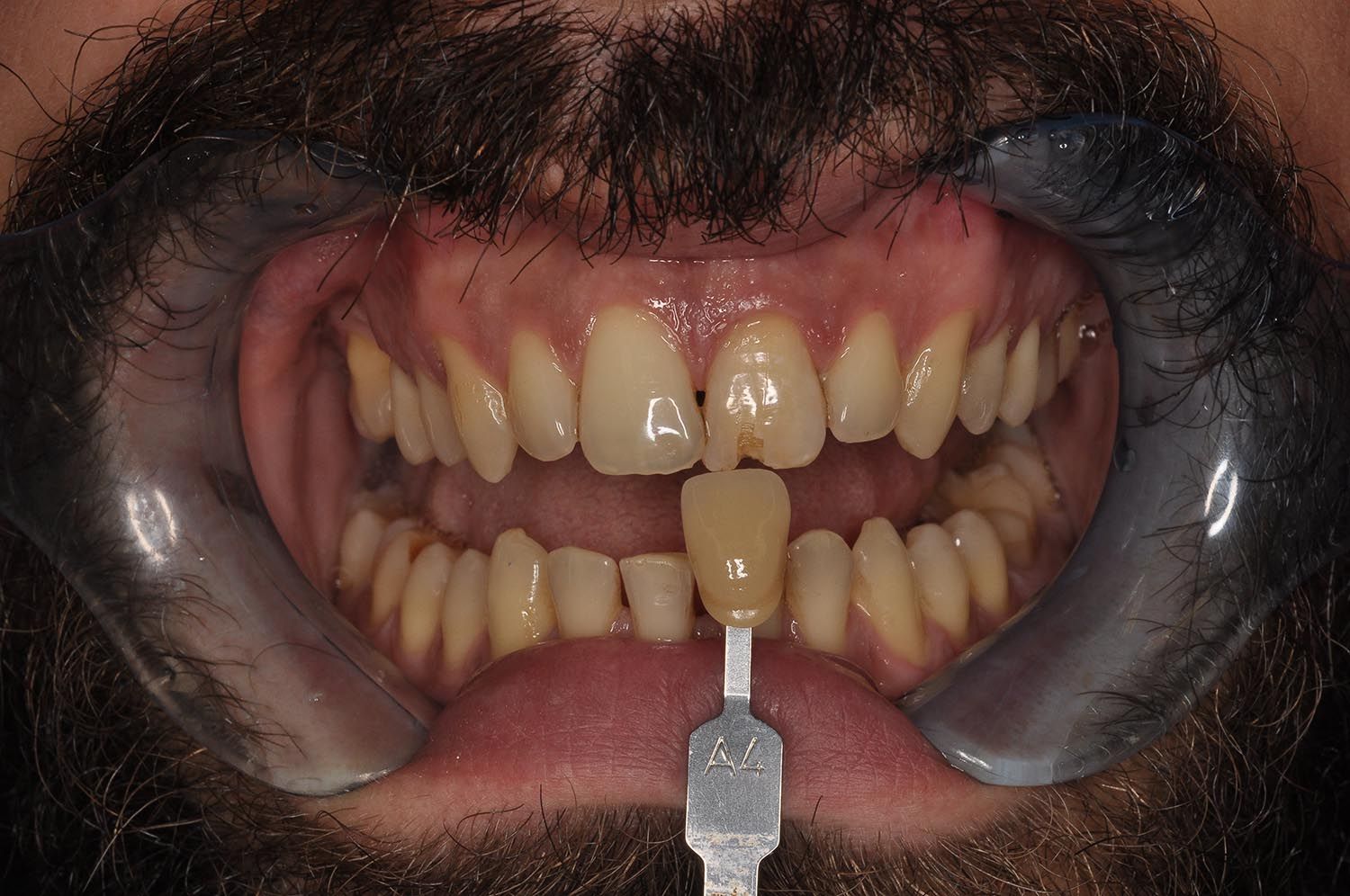Abbinamento del colore dei denti: primo piano dei denti con una linguetta di riferimento del colore a contatto con il dente frontale.