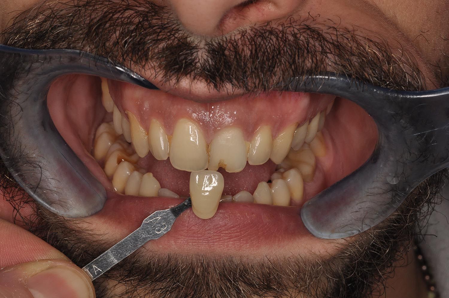 Primo piano della bocca aperta con divaricatori dentali e preparazione di un incisivo centrale superiore visibili.