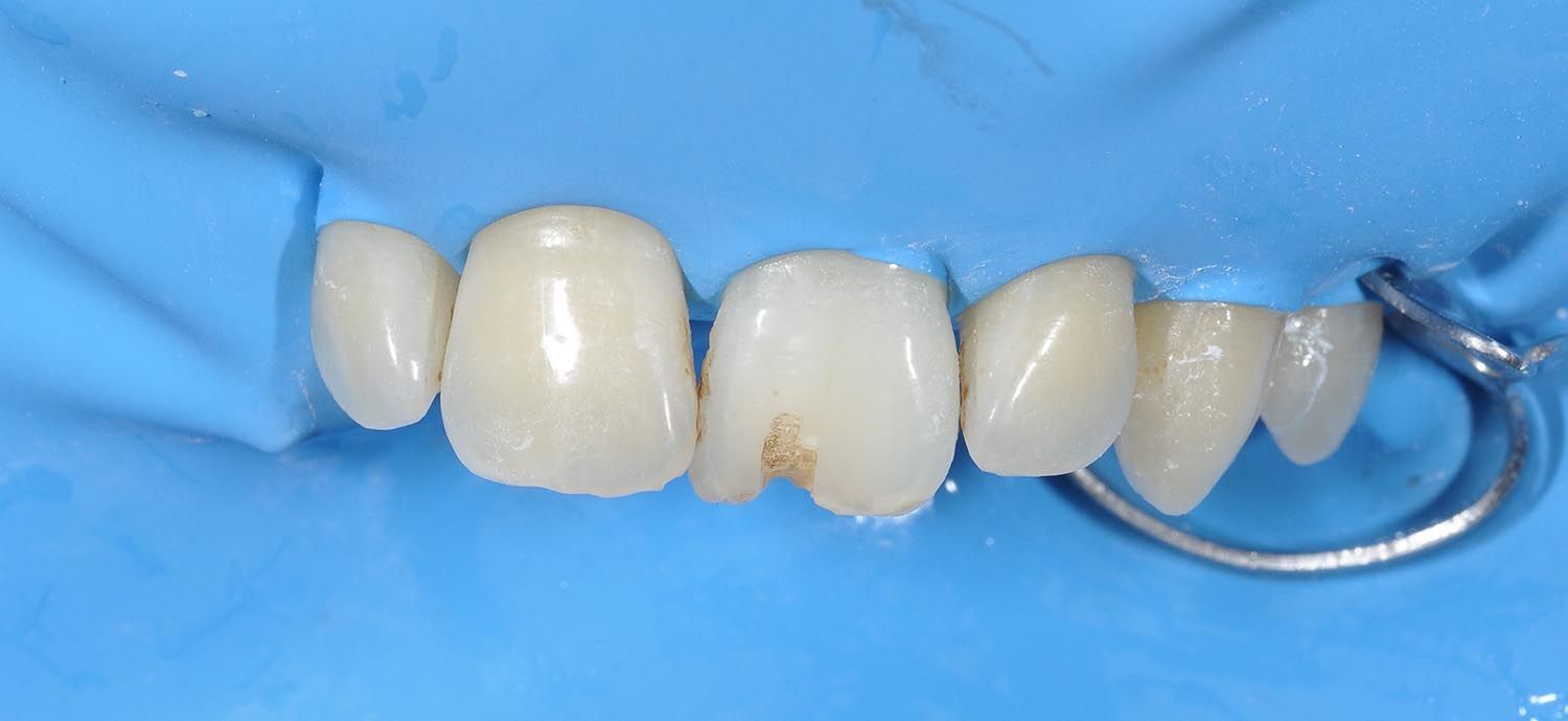 Primo piano dei denti frontali superiori con diga dentale blu e morsetto metallico a destra.
