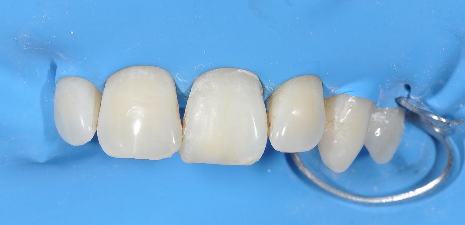 Ponte dentale con diversi denti protesici bianchi su sfondo blu.