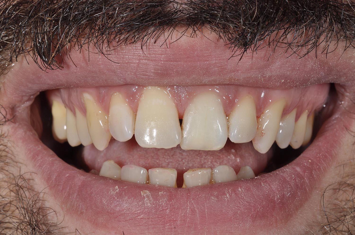 Primo piano della bocca di una persona che mostra i denti incisivi superiori storti e uno spazio tra di essi.