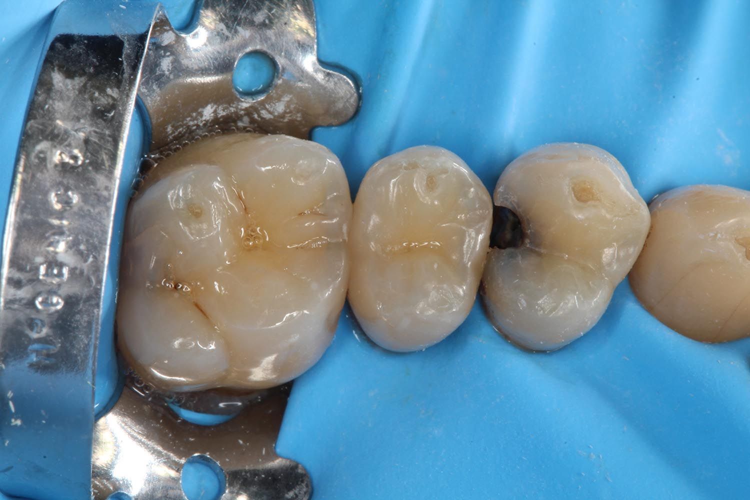 Denti dentali isolati con diga di gomma blu e morsetto metallico durante una procedura odontoiatrica