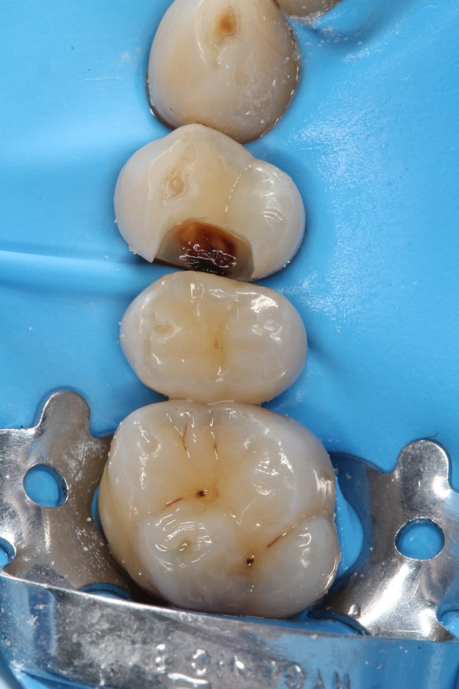 Primo piano di quattro denti con una carie scura ben visibile, isolati da una diga dentale blu e da un morsetto metallico.
