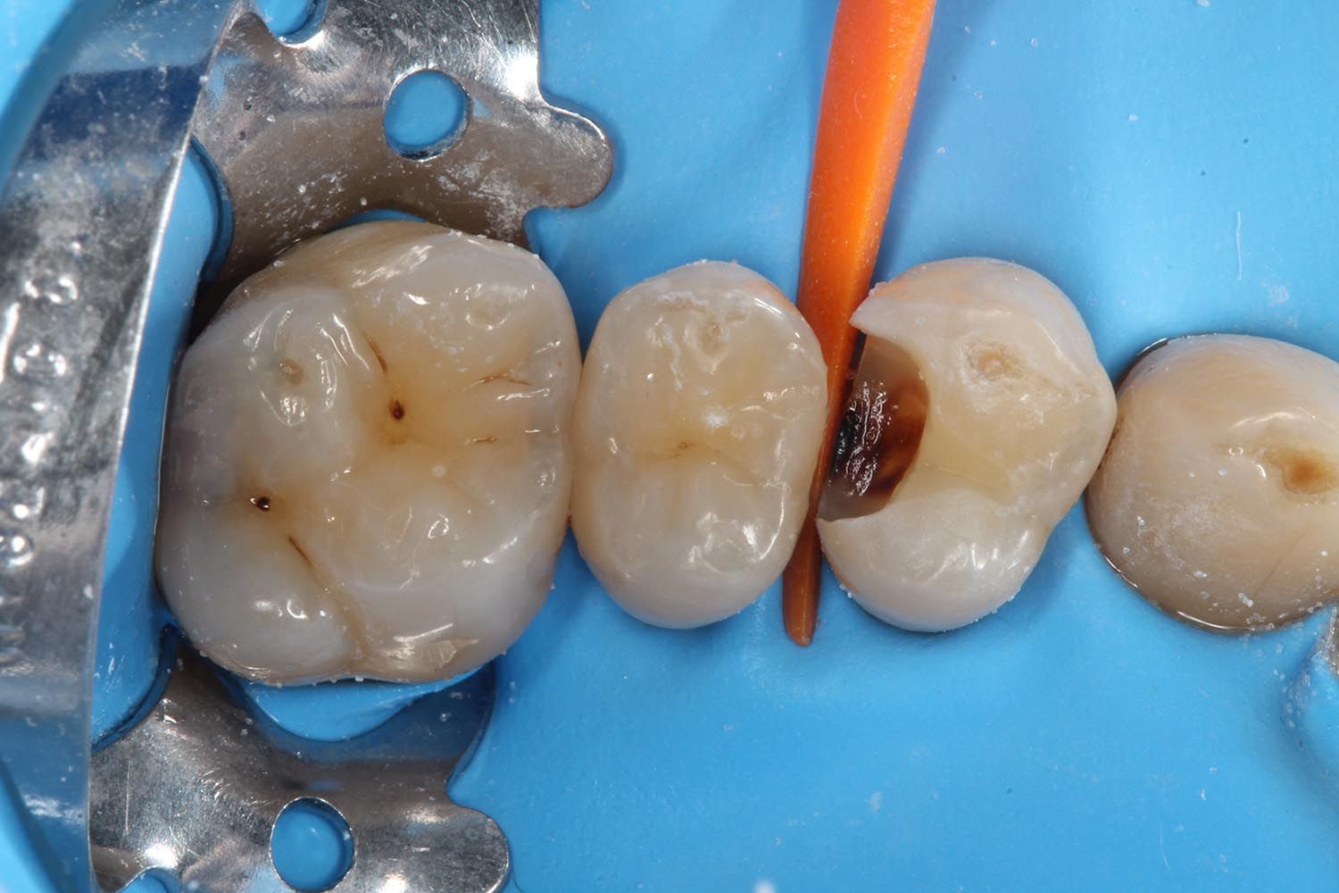 Primo piano dei denti con morsetto dentale e strumento arancione durante una procedura