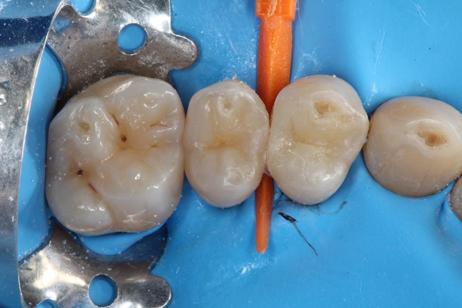 Primo piano di tre denti isolati con una pinza odontoiatrica e un separatore arancione su sfondo blu.