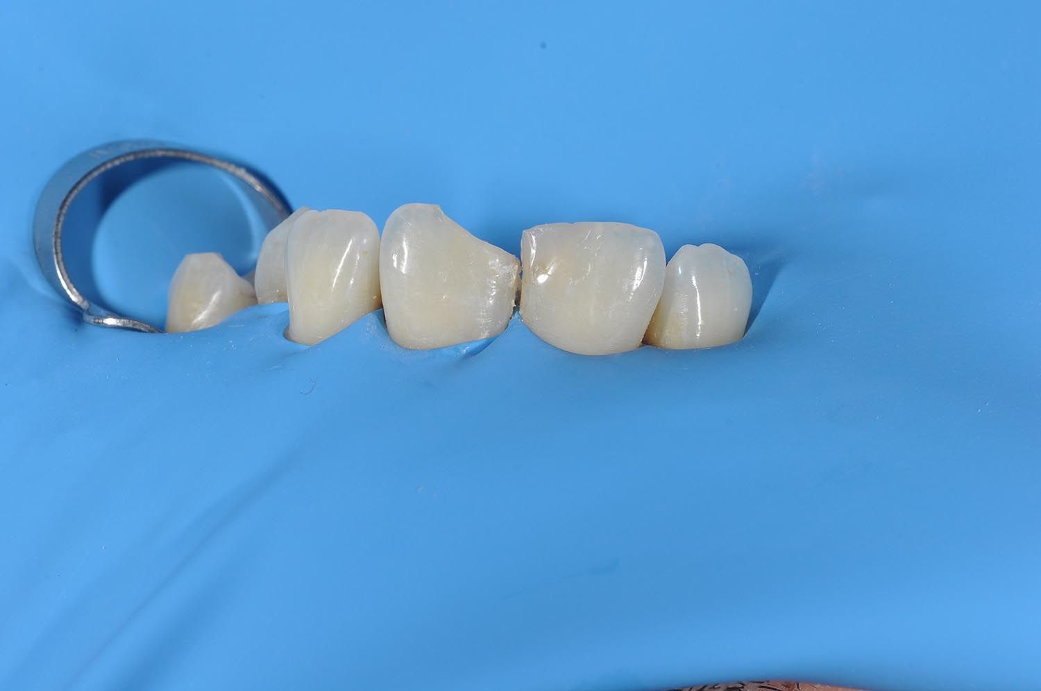 Piccole corone dentali color bianco sporco su una superficie blu accanto a un anello di metallo