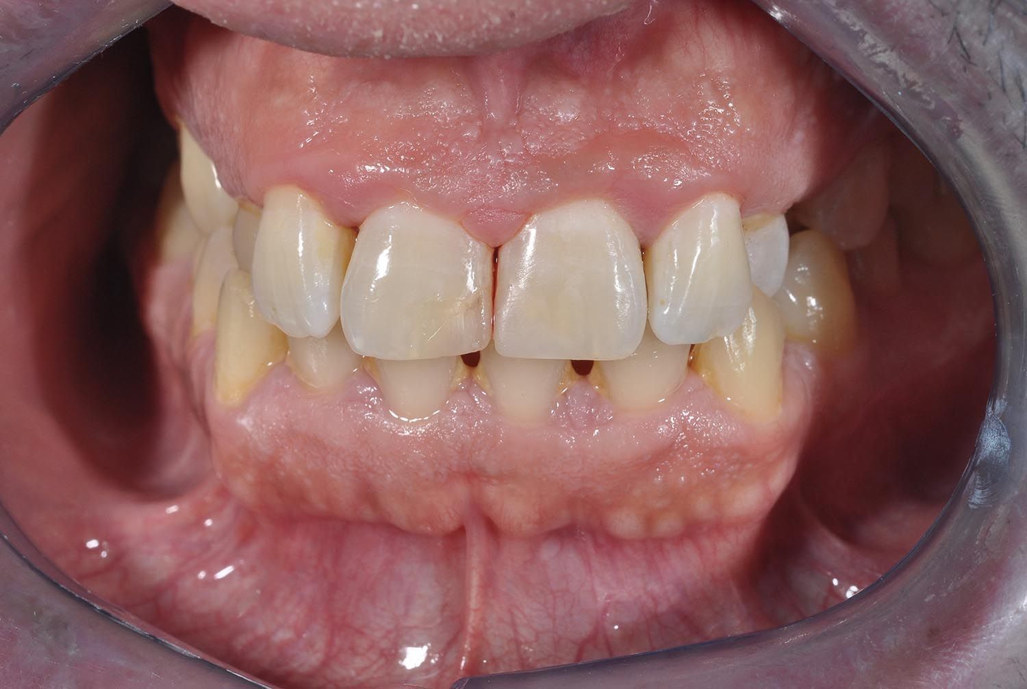 Primo piano dei denti e delle gengive di una persona all'interno di un divaricatore orale, che mostra i denti anteriori e uno spazio