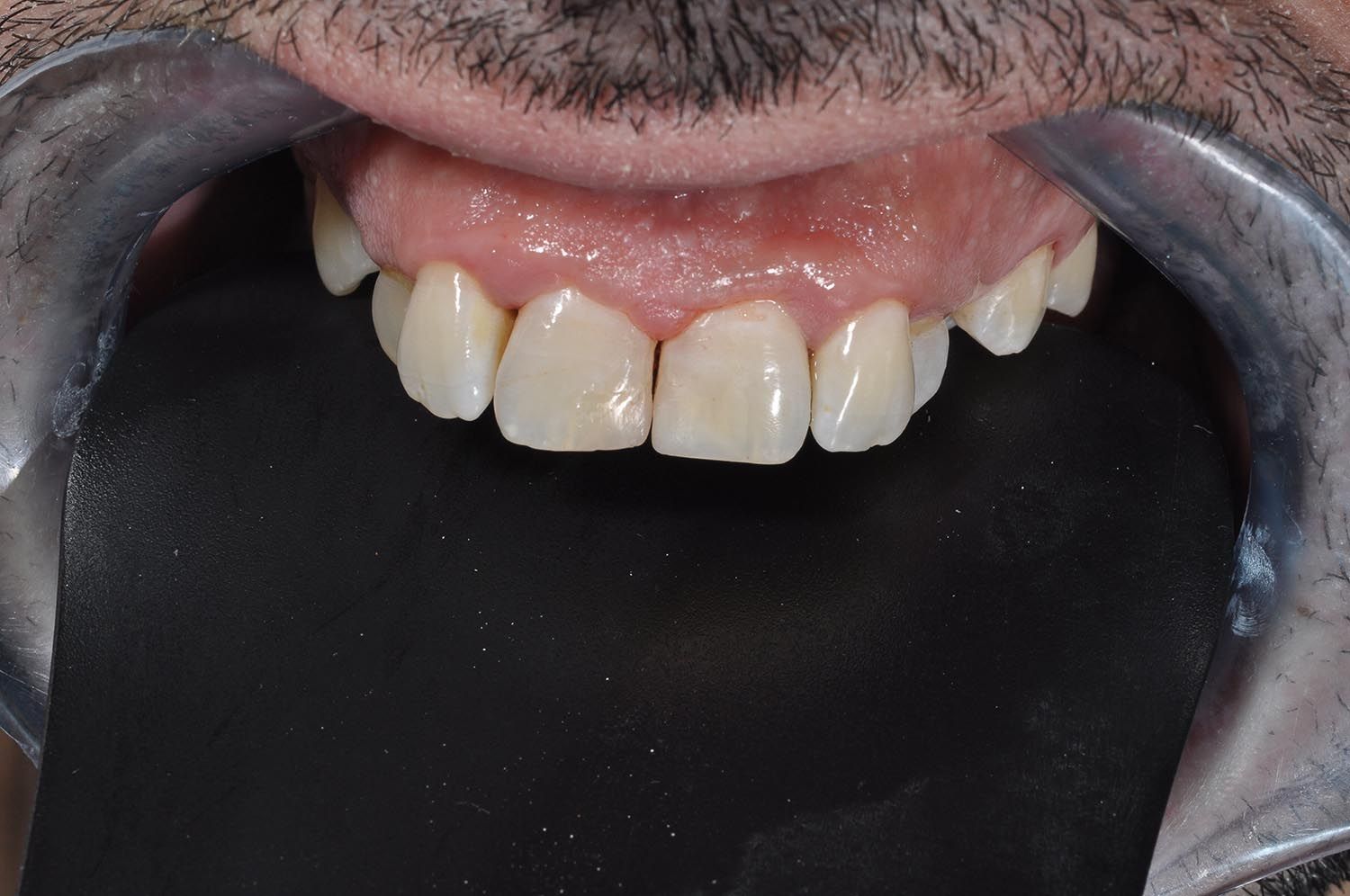 Primo piano dei denti frontali superiori con un divaricatore, che mostra discromie e spazi tra i denti.