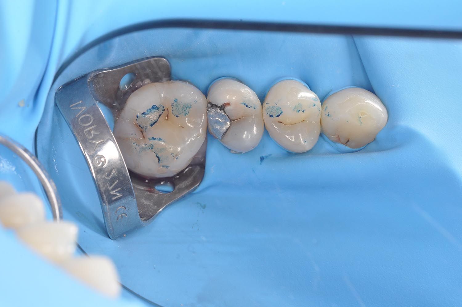 Primo piano di denti dentali sotto una diga di gomma blu con un morsetto metallico e materiale di riempimento riflettente