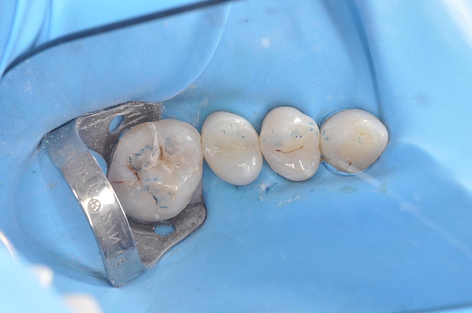 Denti dentali isolati con diga di gomma e morsetto metallico durante una procedura