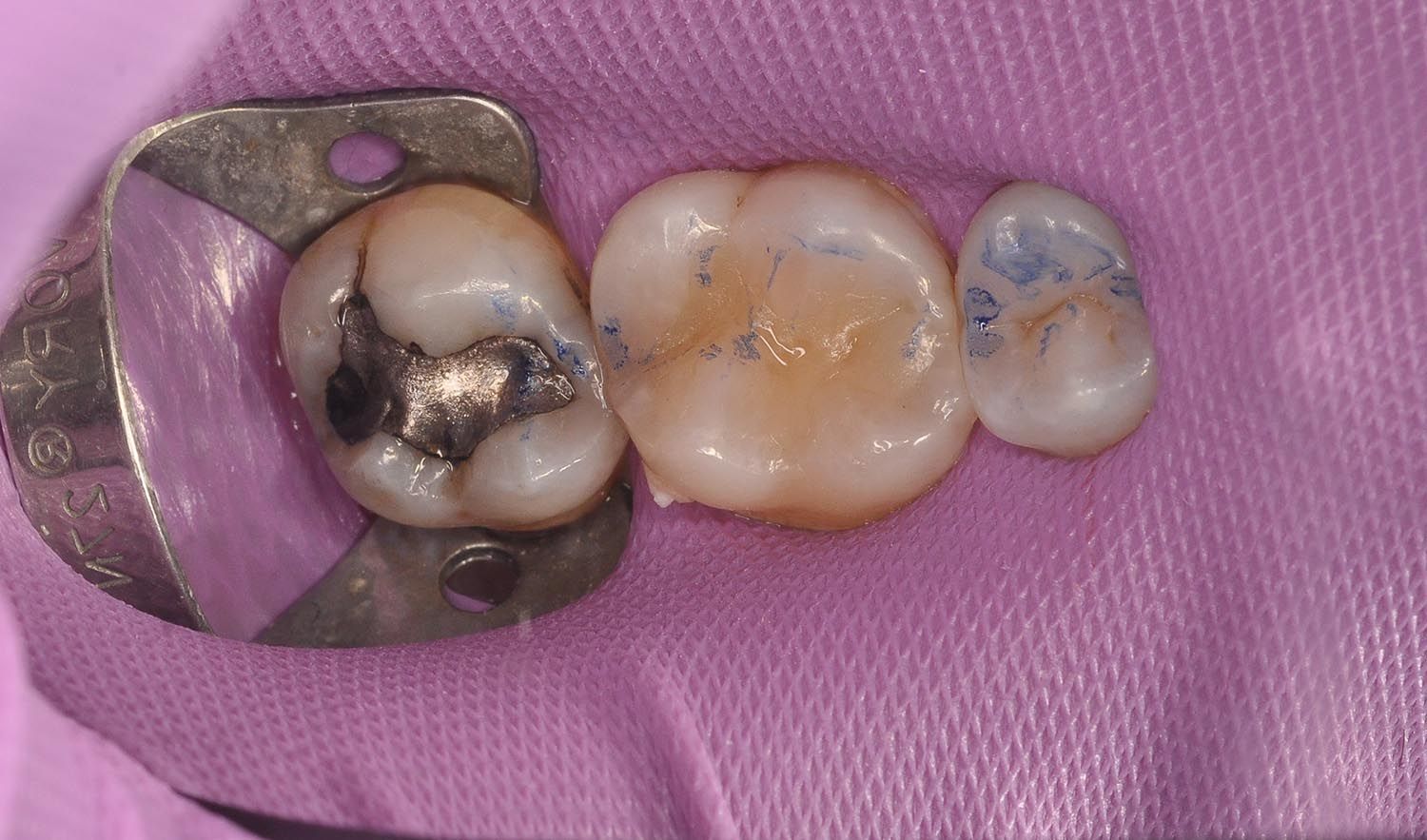 Tre denti estratti su un telo odontoiatrico rosa, tra cui uno con un'otturazione in amalgama d'argento.