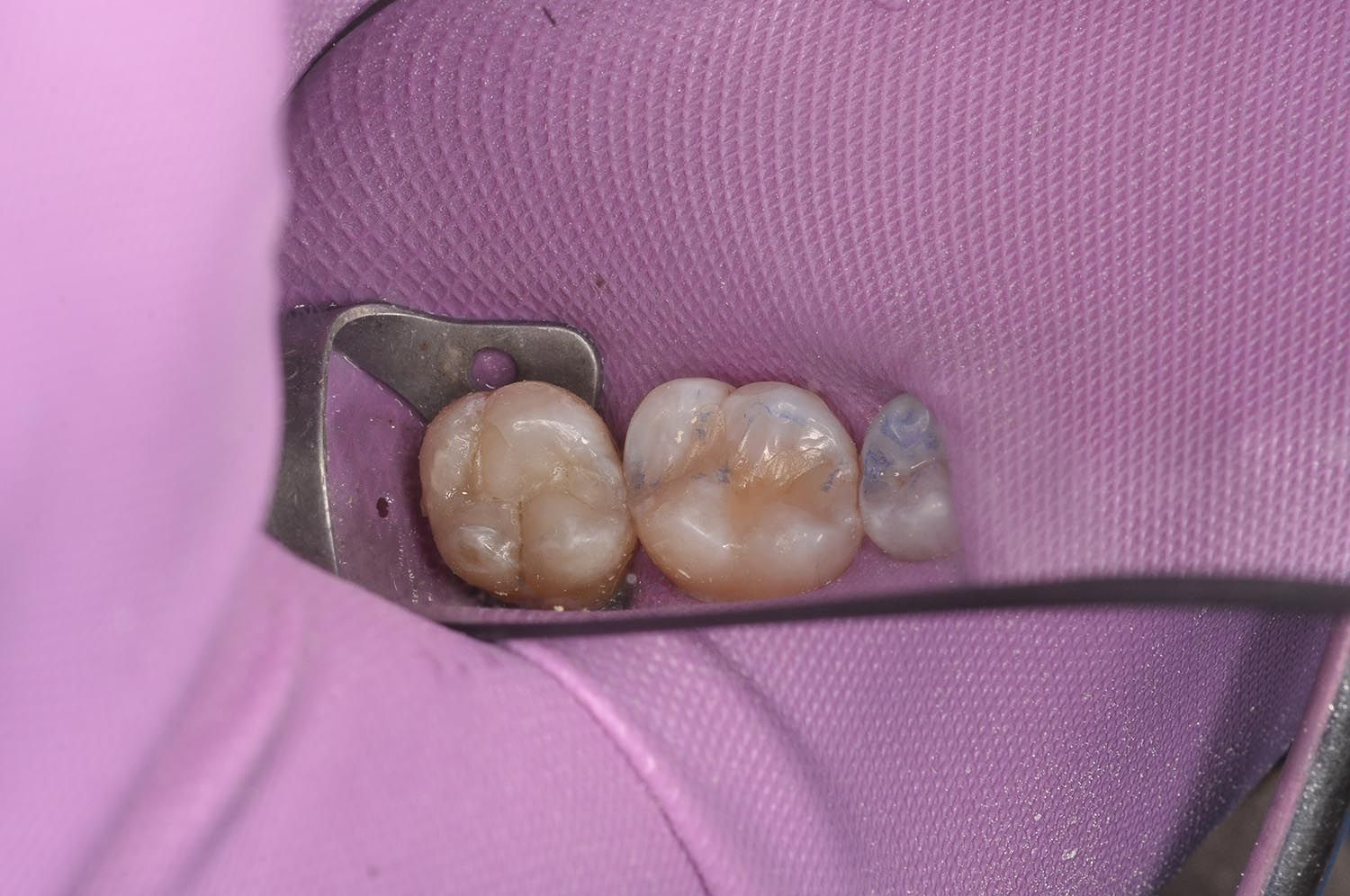 Due molari isolati con diga di gomma dentale e morsetto metallico