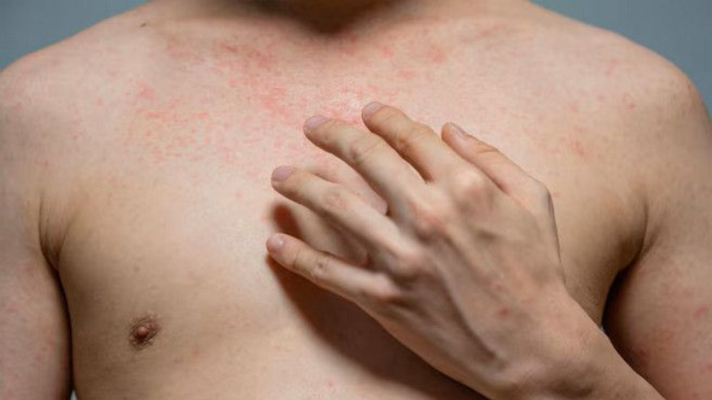 Qué es la psoriasis genital