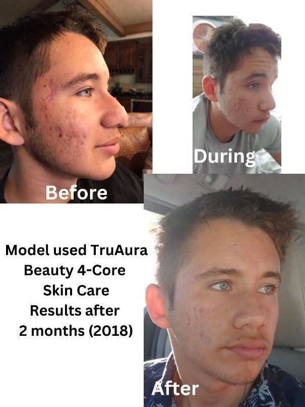 Seeing is Believing Before & After TrūAura Skincare Products