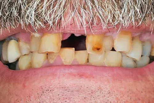 before crown implants