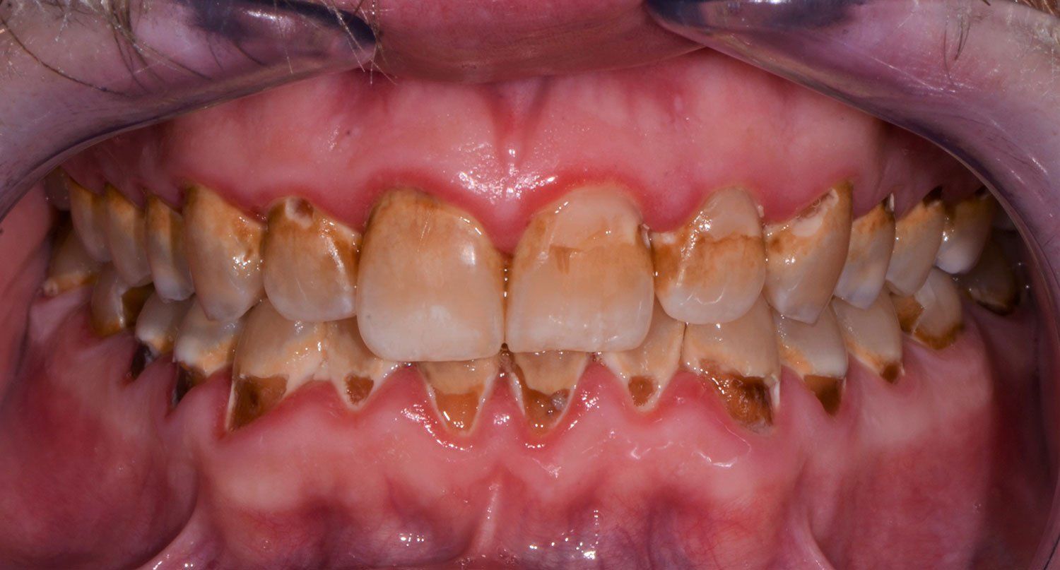 Before