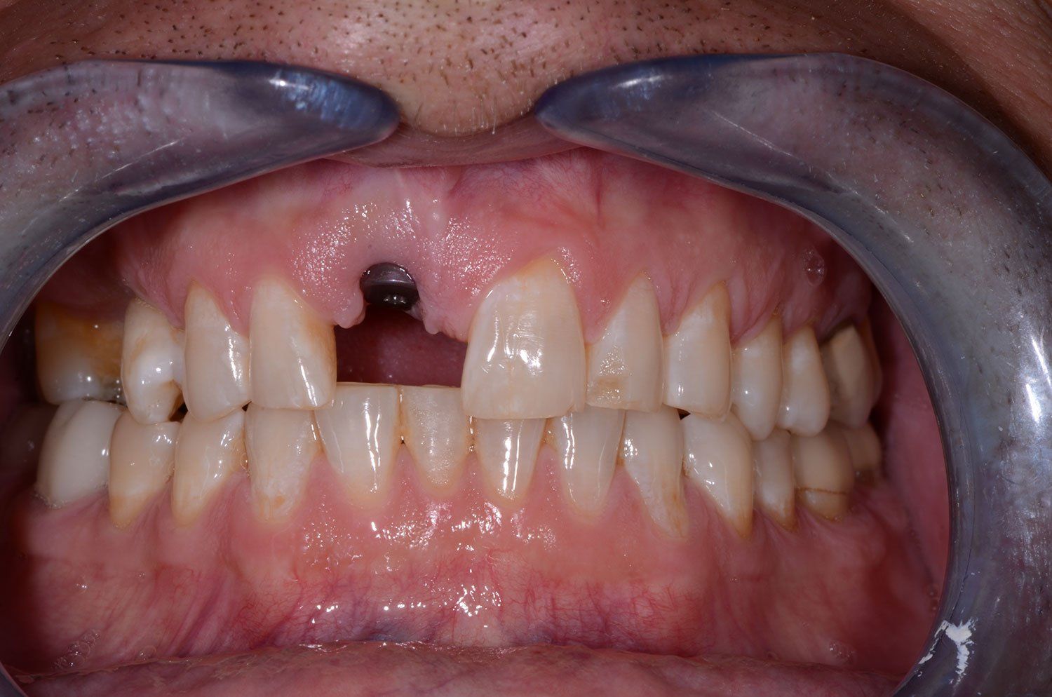 before smile makeover