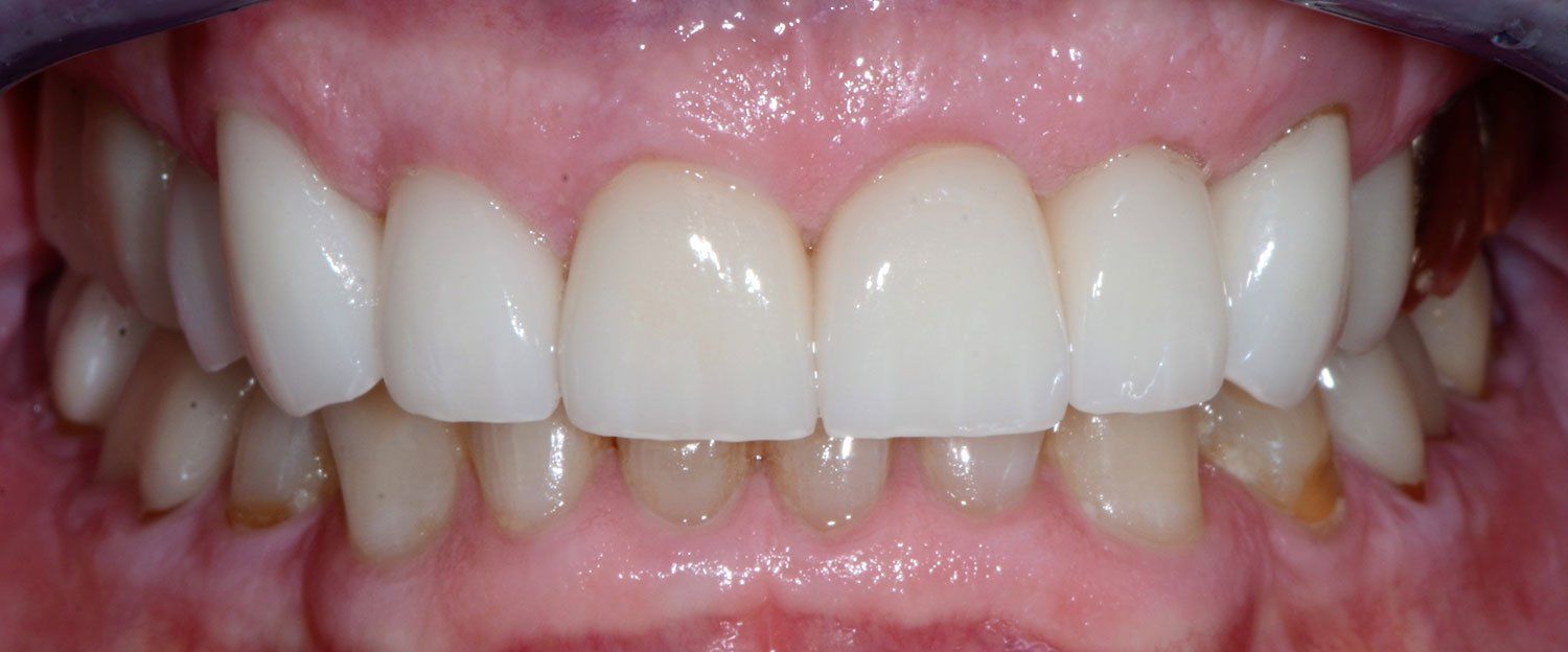 after invisalign