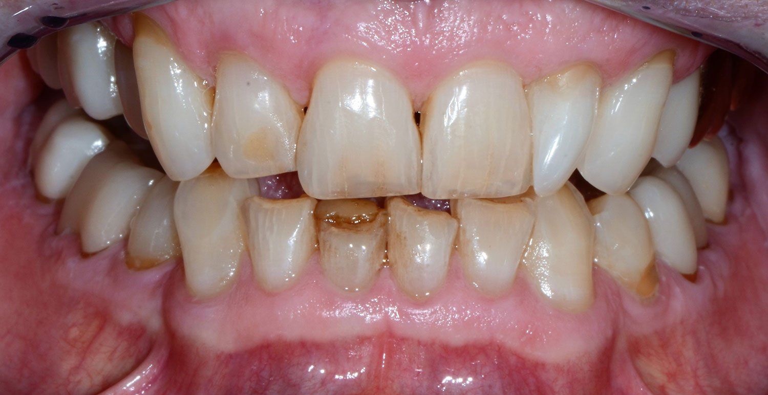 before invisalign