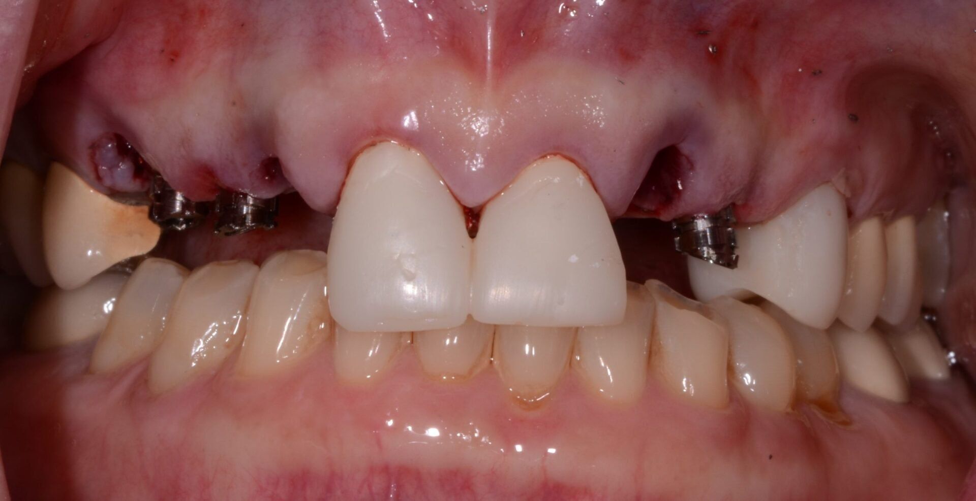 Before