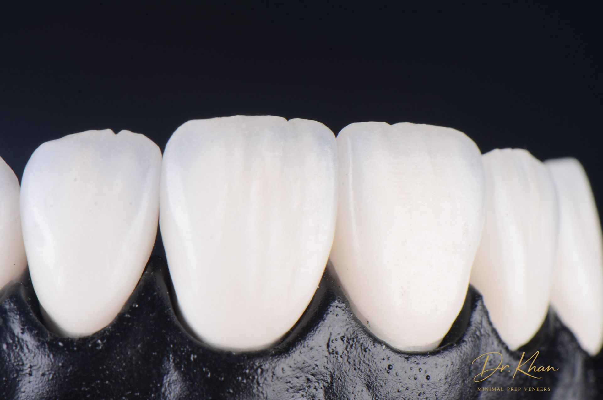 Close-up of porcelain veneers shade-matched to natural teeth, Arlington, TX