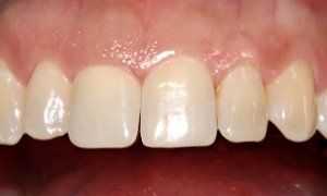 A close up of a person 's teeth with white teeth.
