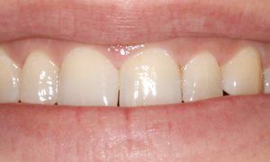 A close up of a person 's mouth with white teeth.
