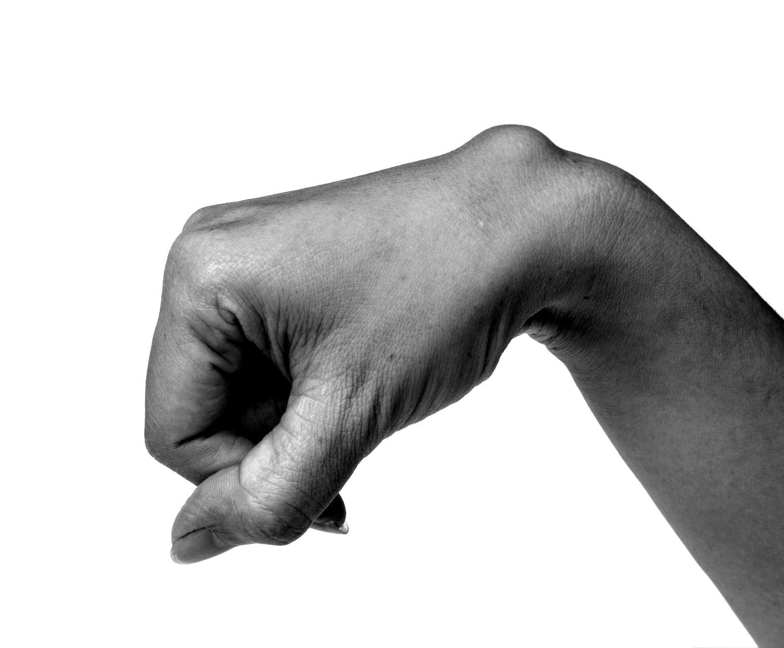 closeup of hand with ganglion cyst on wrist