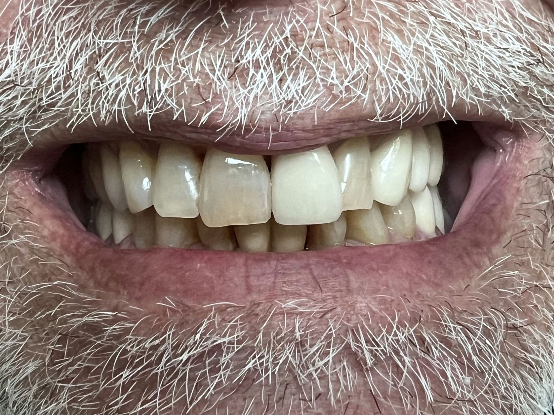 A close up of a woman 's mouth with white teeth.