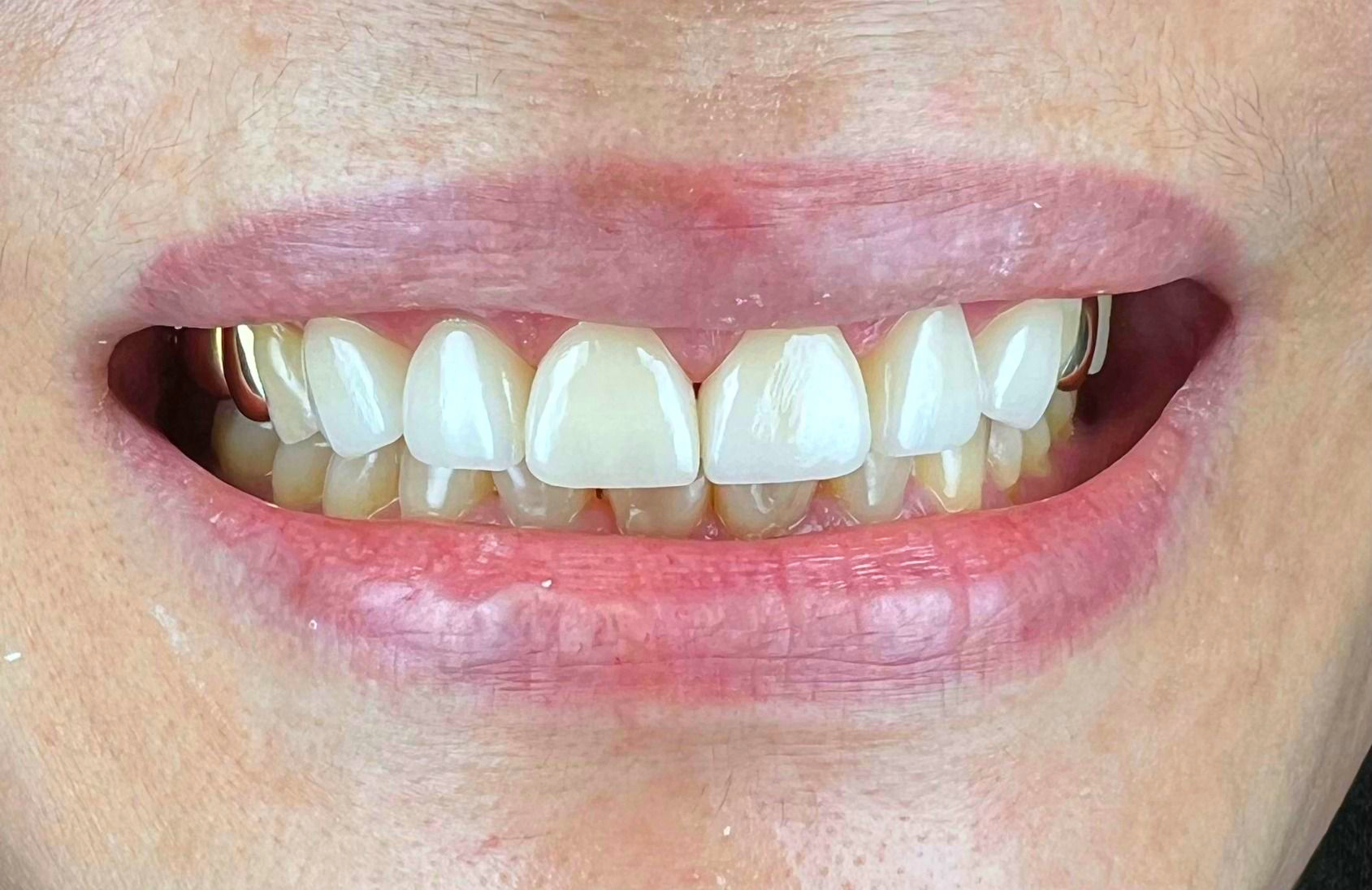 A close up of a woman 's teeth with white teeth.
