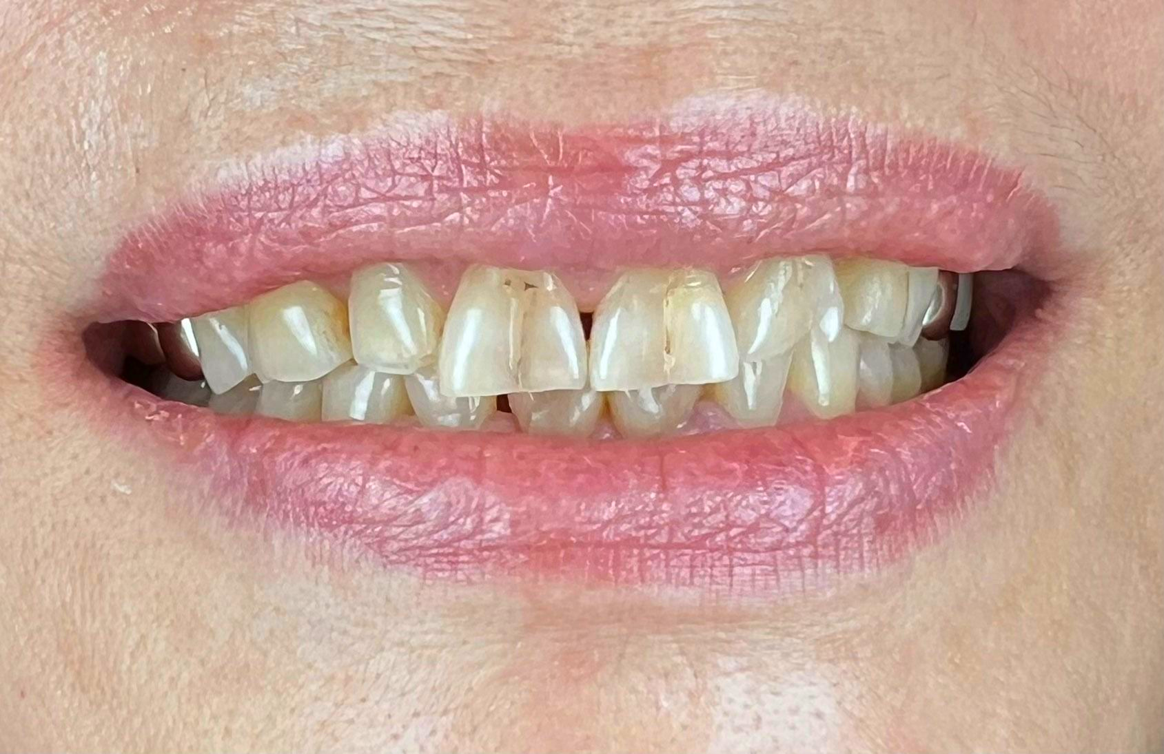 A close up of a woman 's mouth with white teeth.
