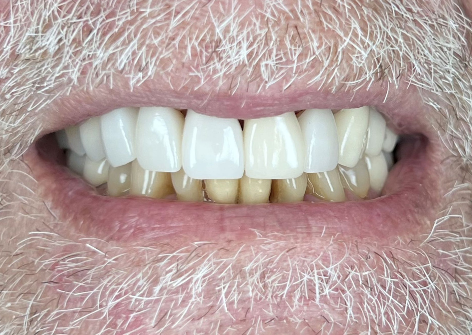 A close up of a woman 's teeth with white teeth.