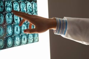 Hand pointing at a brain scan display with multiple blue MRI images