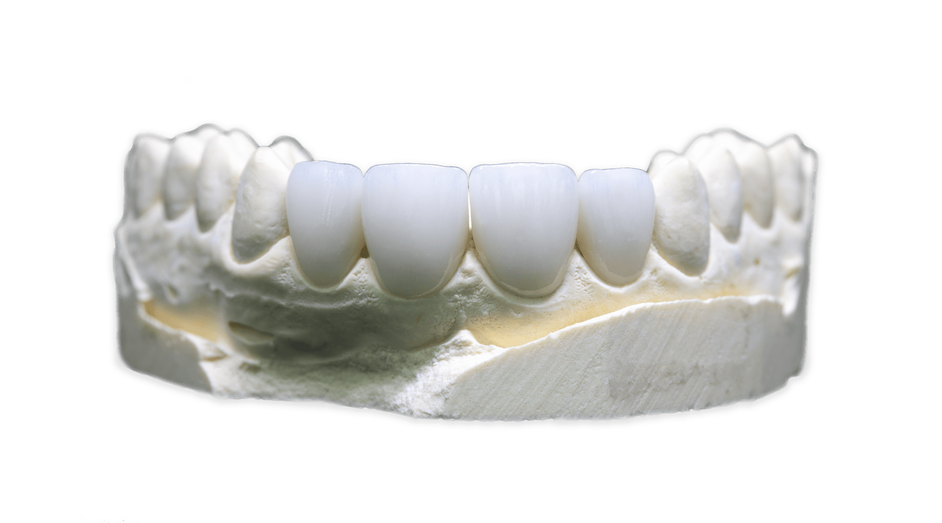 Porcelain Fused to Zirconia