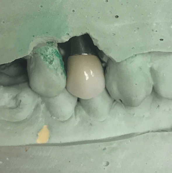 Dental labs in Westfield, MA 