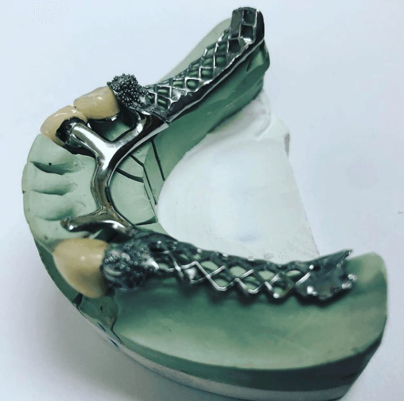 cast metal partials