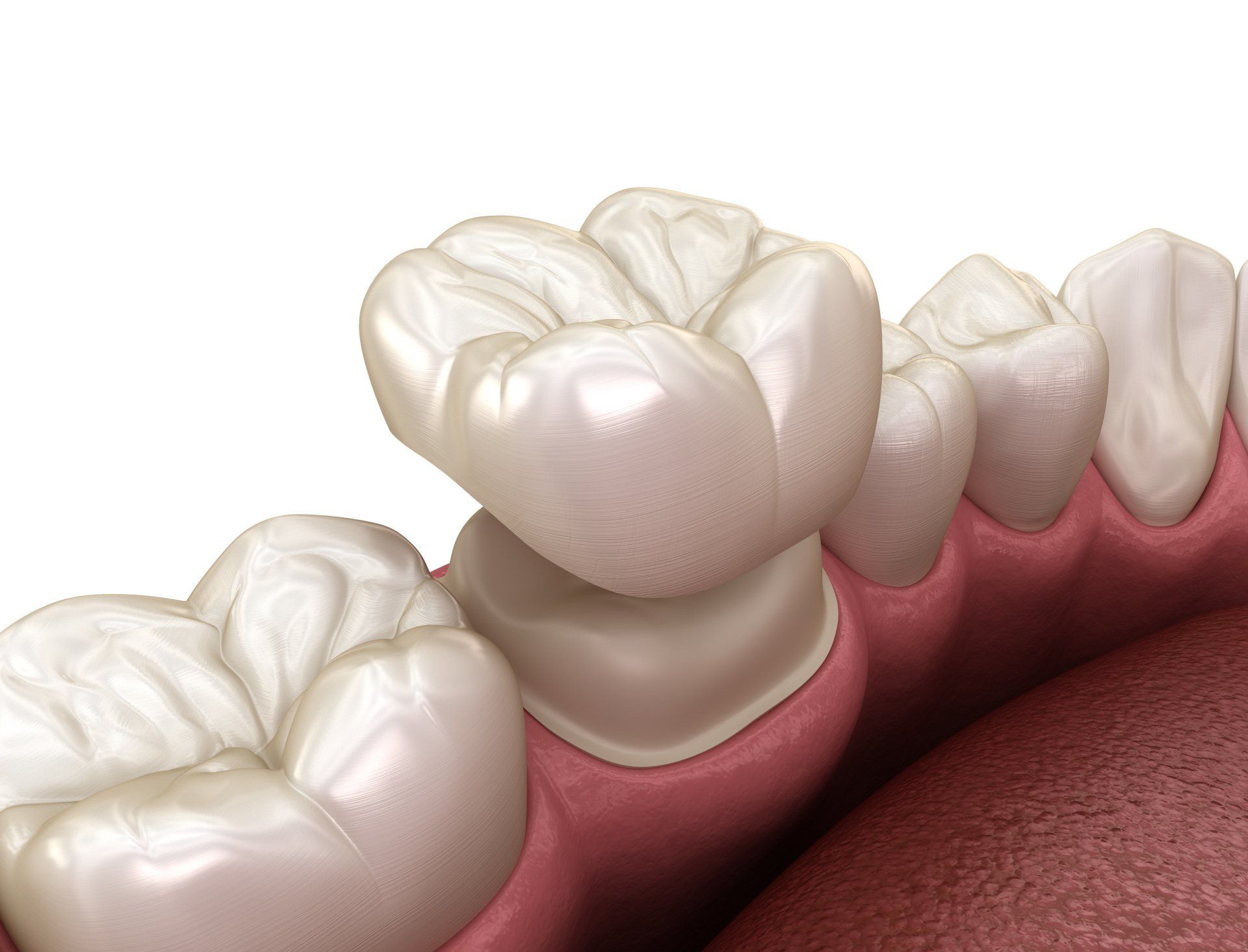 benefits of zirconia dental crowns
